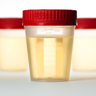 urin sakupljanje 24h uzorka urina